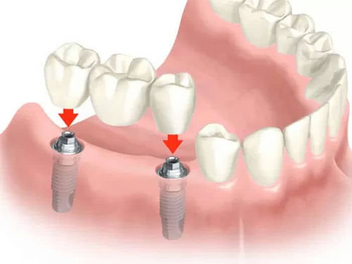Schematische Darstellung: Einsatz von Zahnimplantaten im Unterkiefer