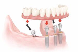 Schema: Einsatz der All-on-4 Technologie