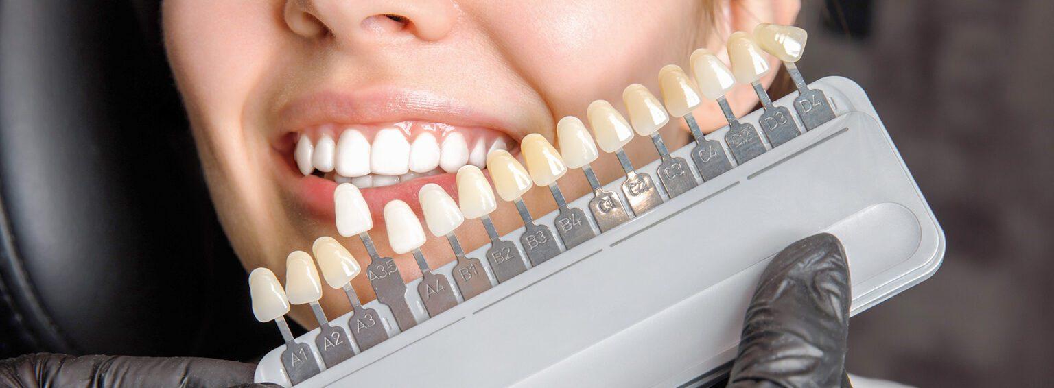 Veneers oder Bleaching? Kosten und Möglichkeiten im Vergleich